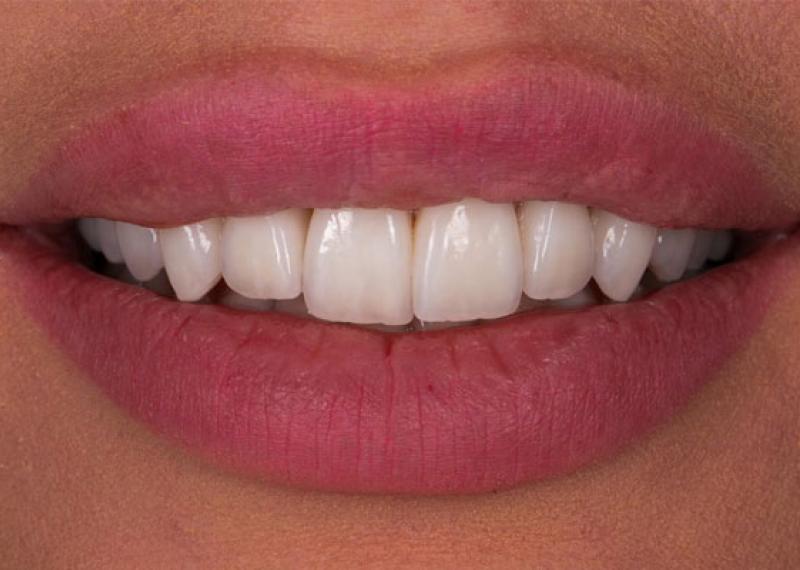 Veneers bei Zahntechnik Krieger