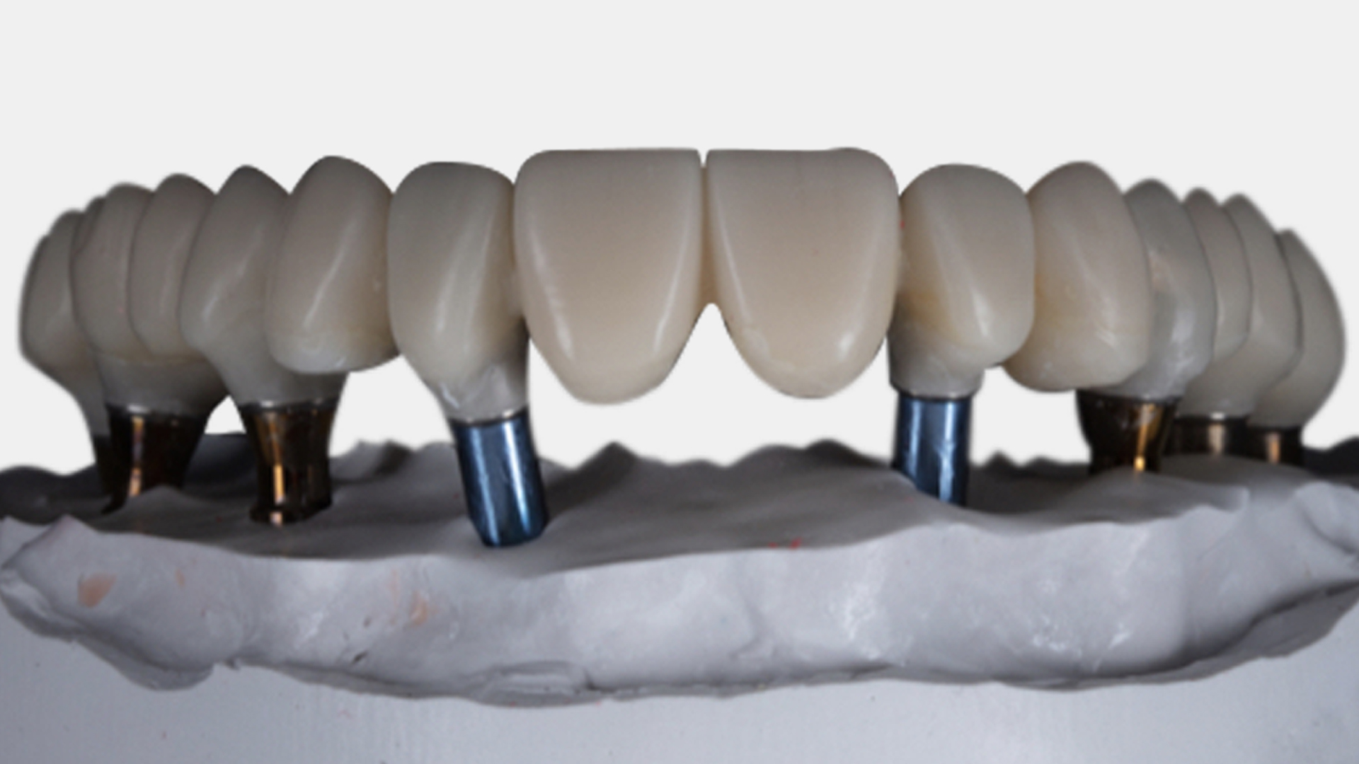 Implantat-Suprakonstruktionen