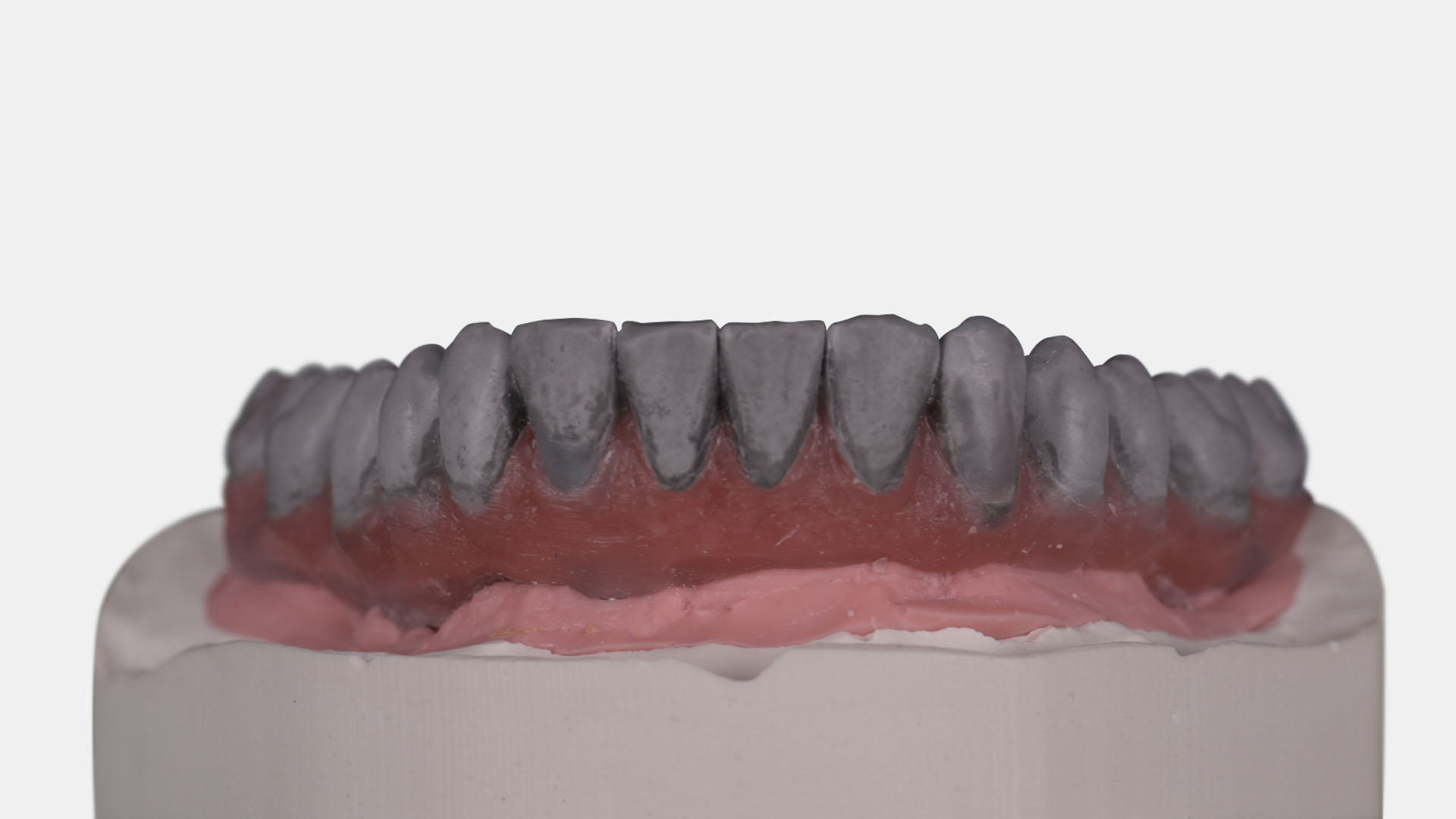 Implantat-Suprakonstruktionen