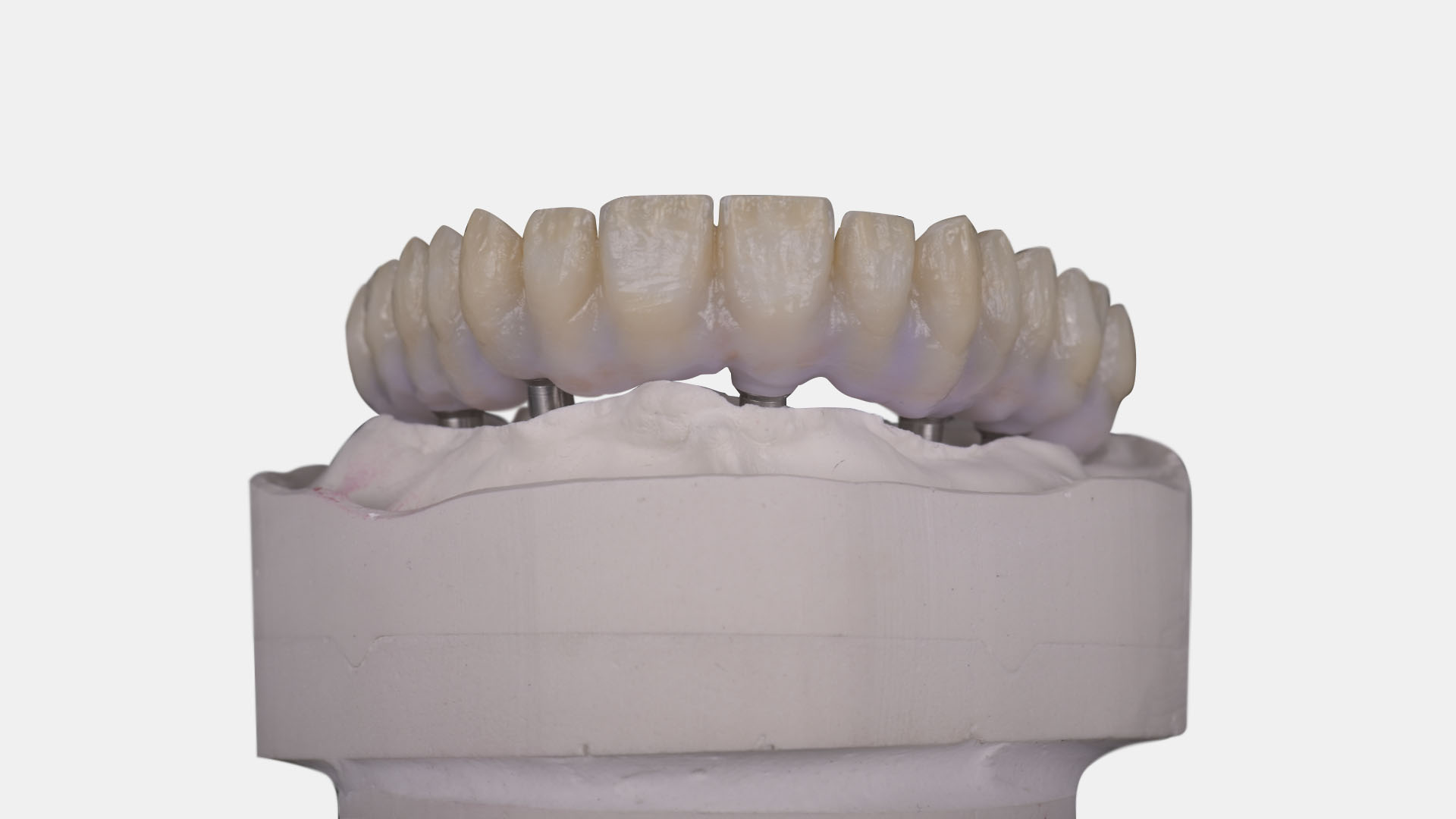 Implantat-Suprakonstruktionen