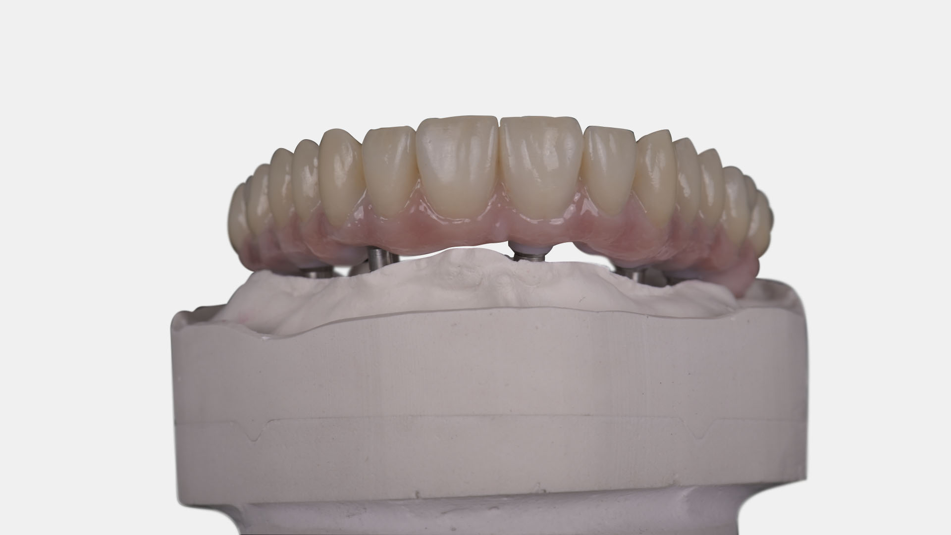 Implantat-Suprakonstruktionen