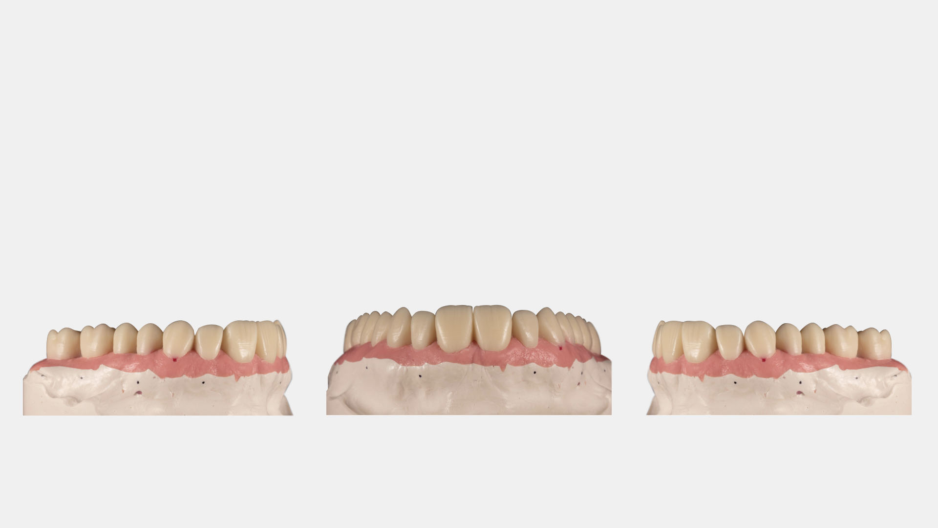 Implantat-Suprakonstruktionen