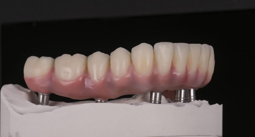 Zahntechnik Krieger Implantate Beispiel Case 3