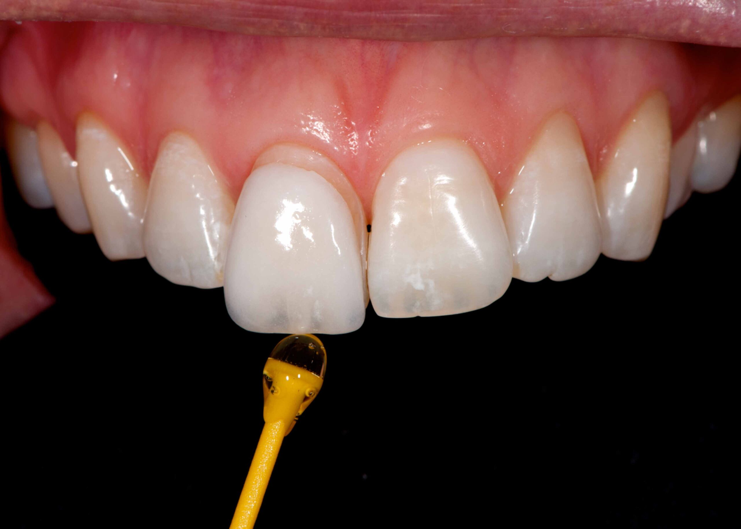 Veneers Case 01