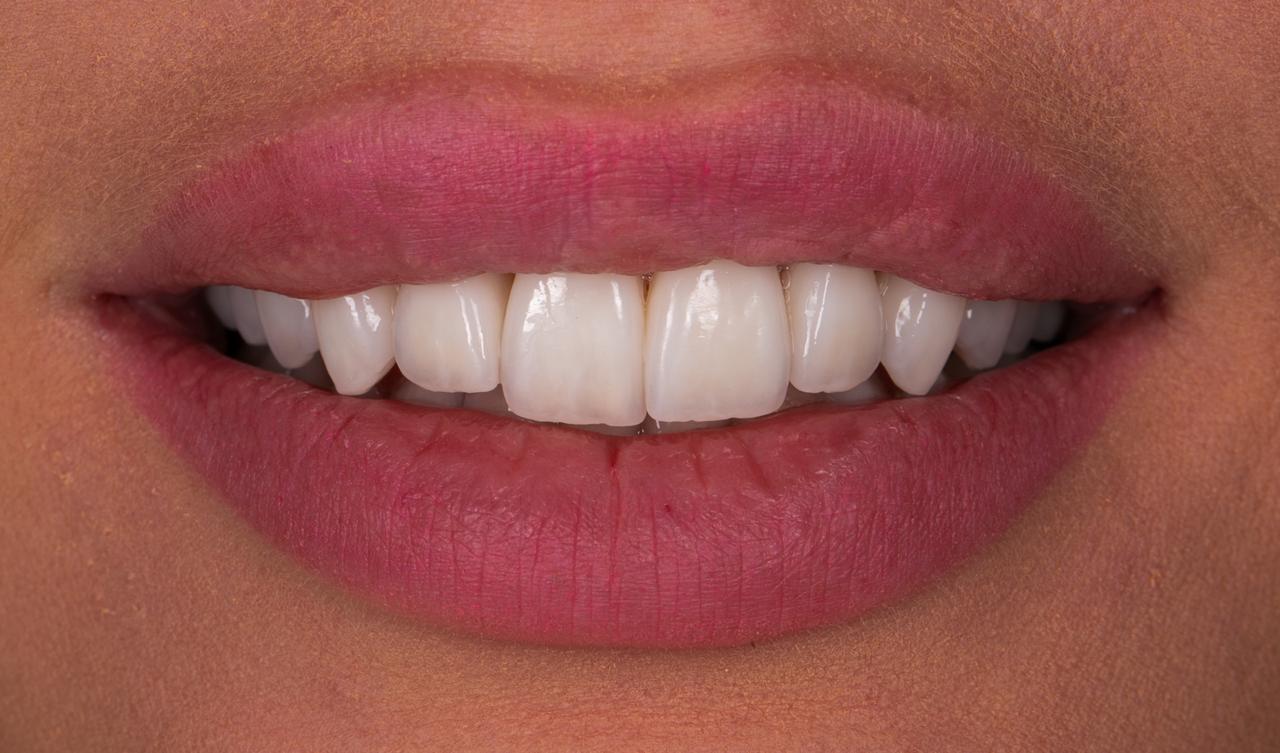 Veneers Case 03